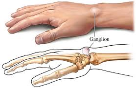 ganglion cyst.jpg